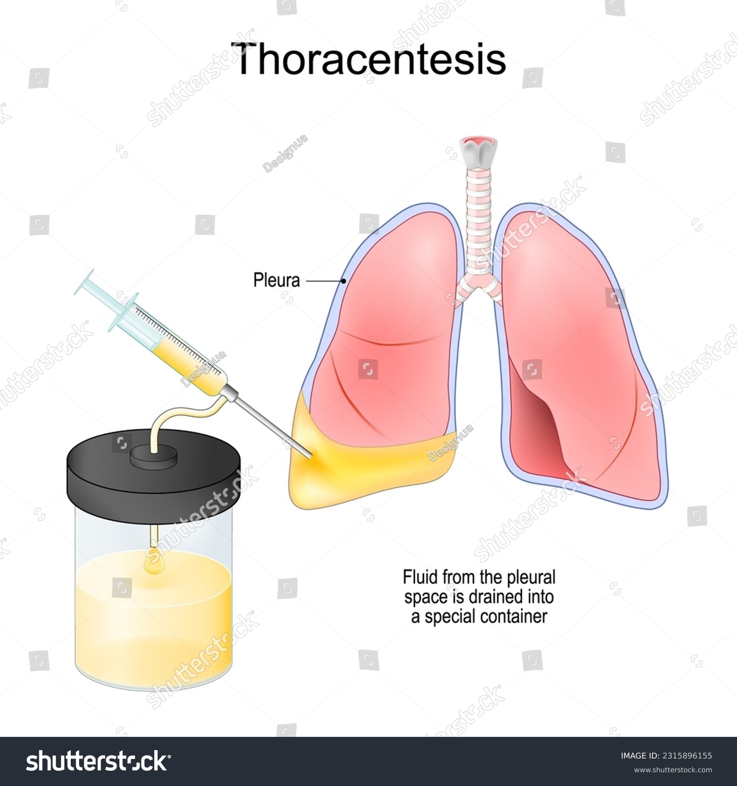 Thoracentesis. Thoracocentesis is an invasive - Royalty Free Stock ...