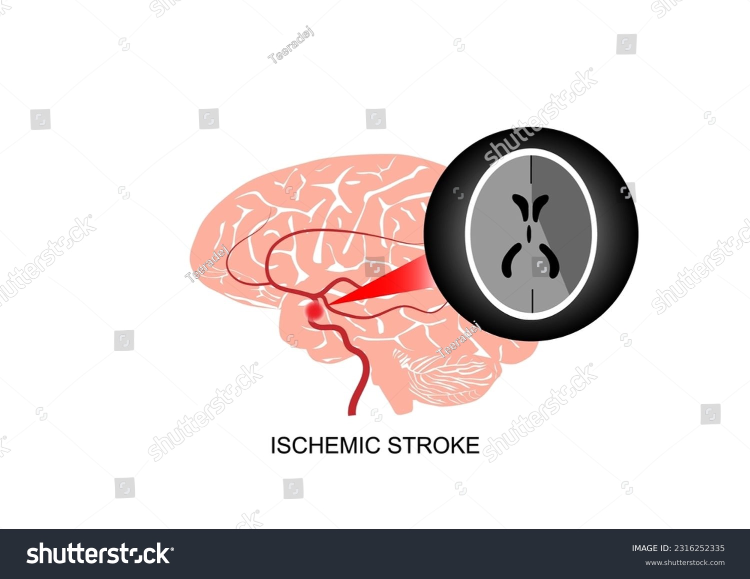 Illustration Of Cerebral Infarction Or Ischemic Royalty Free Stock Vector 2316252335