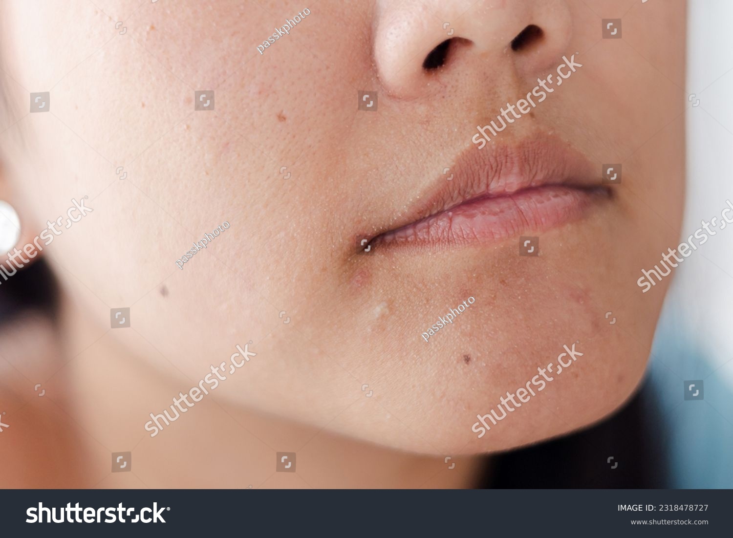 close up in selective focus of a chin with large amount of blackheads and dilated pores. Blemishes of oily and combination skin. Rough face skin with blackheads in relief. #2318478727