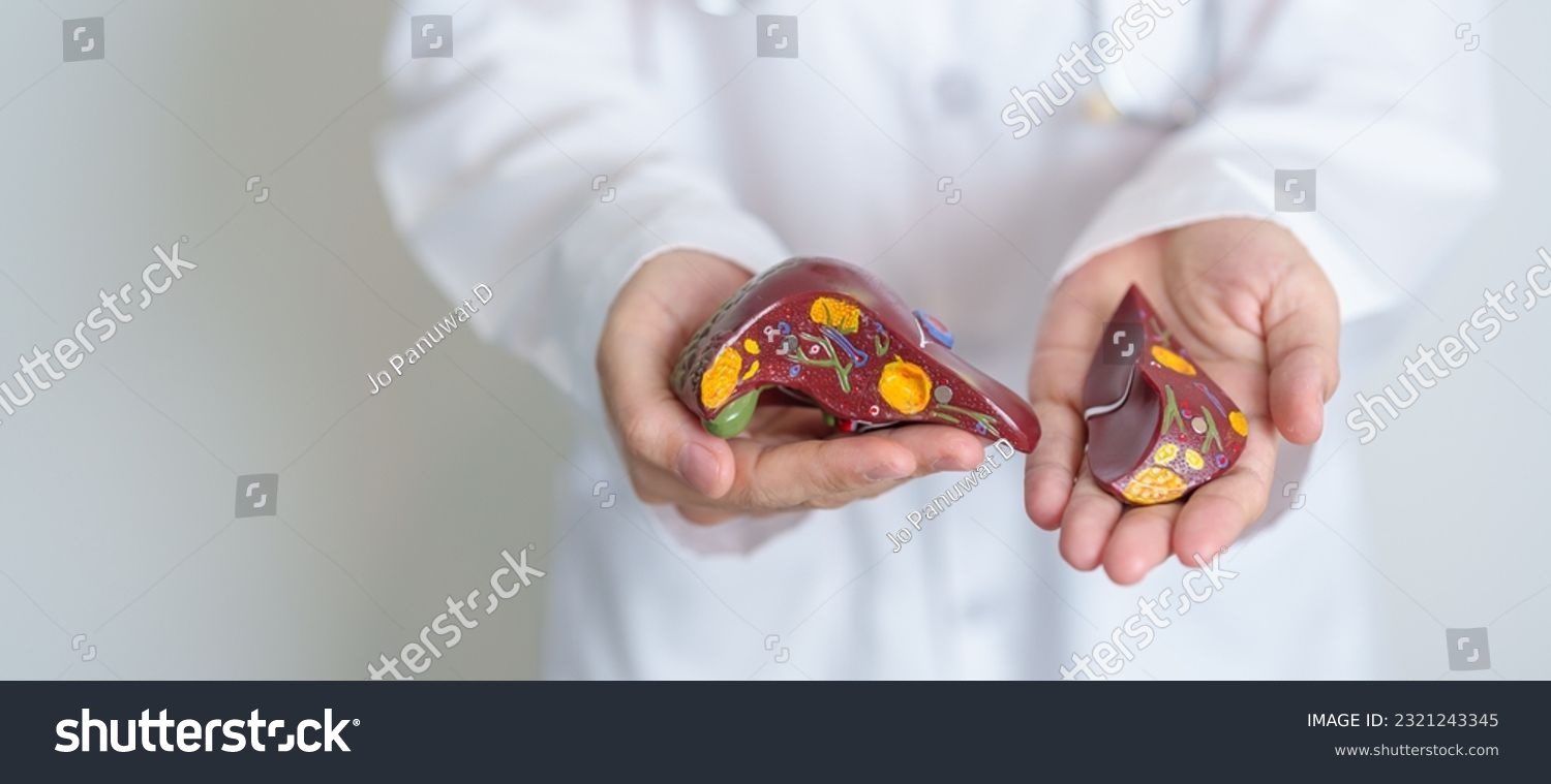 Doctor holding human Liver anatomy model. Liver cancer and Tumor, Jaundice, Viral Hepatitis A, B, C, D, E, Cirrhosis, Failure, Enlarged, Hepatic Encephalopathy, Ascites Fluid in Belly and health #2321243345