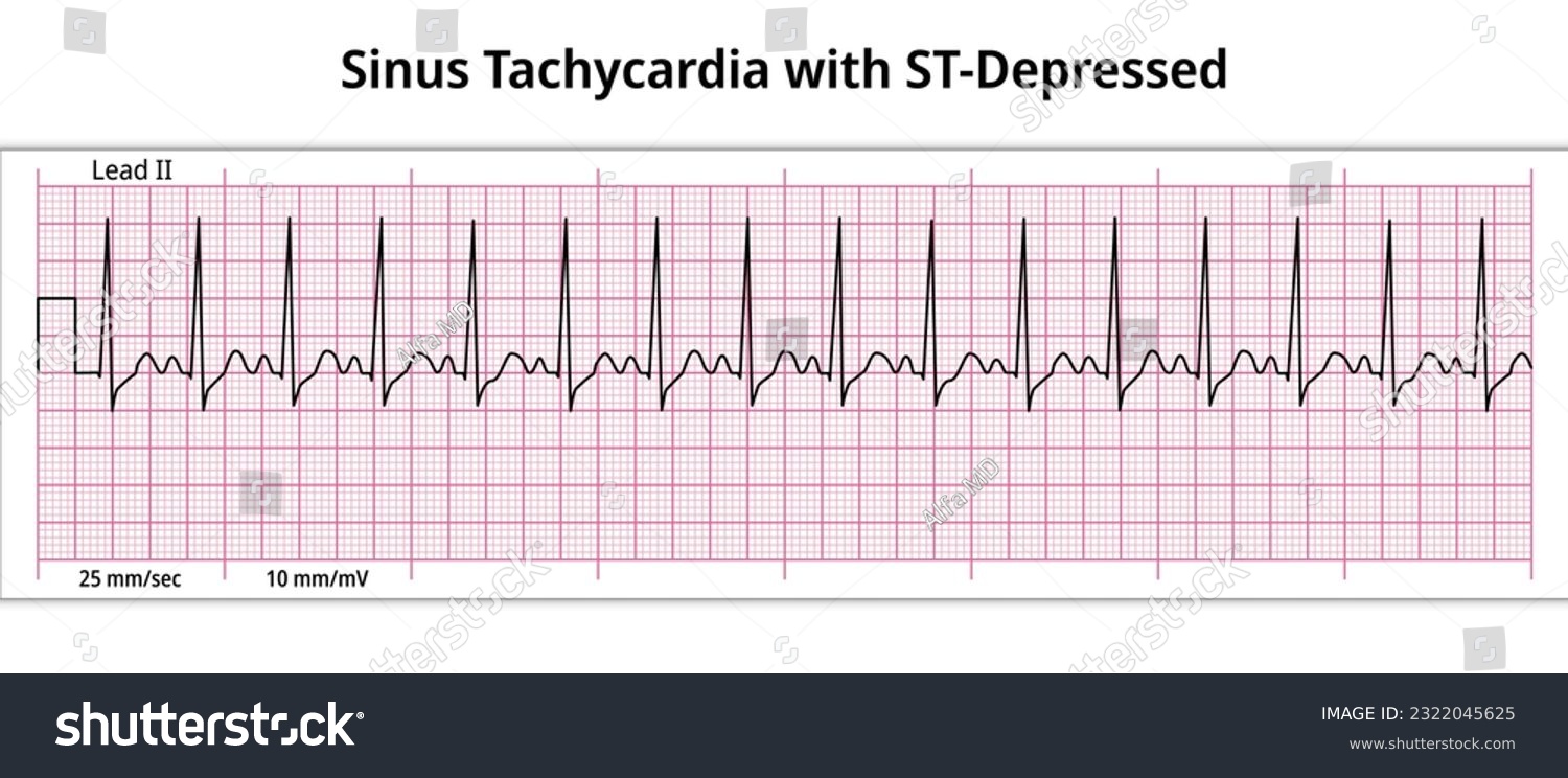 Sinus Tachycardia with ST-Segment Depressed - 8 - Royalty Free Stock ...