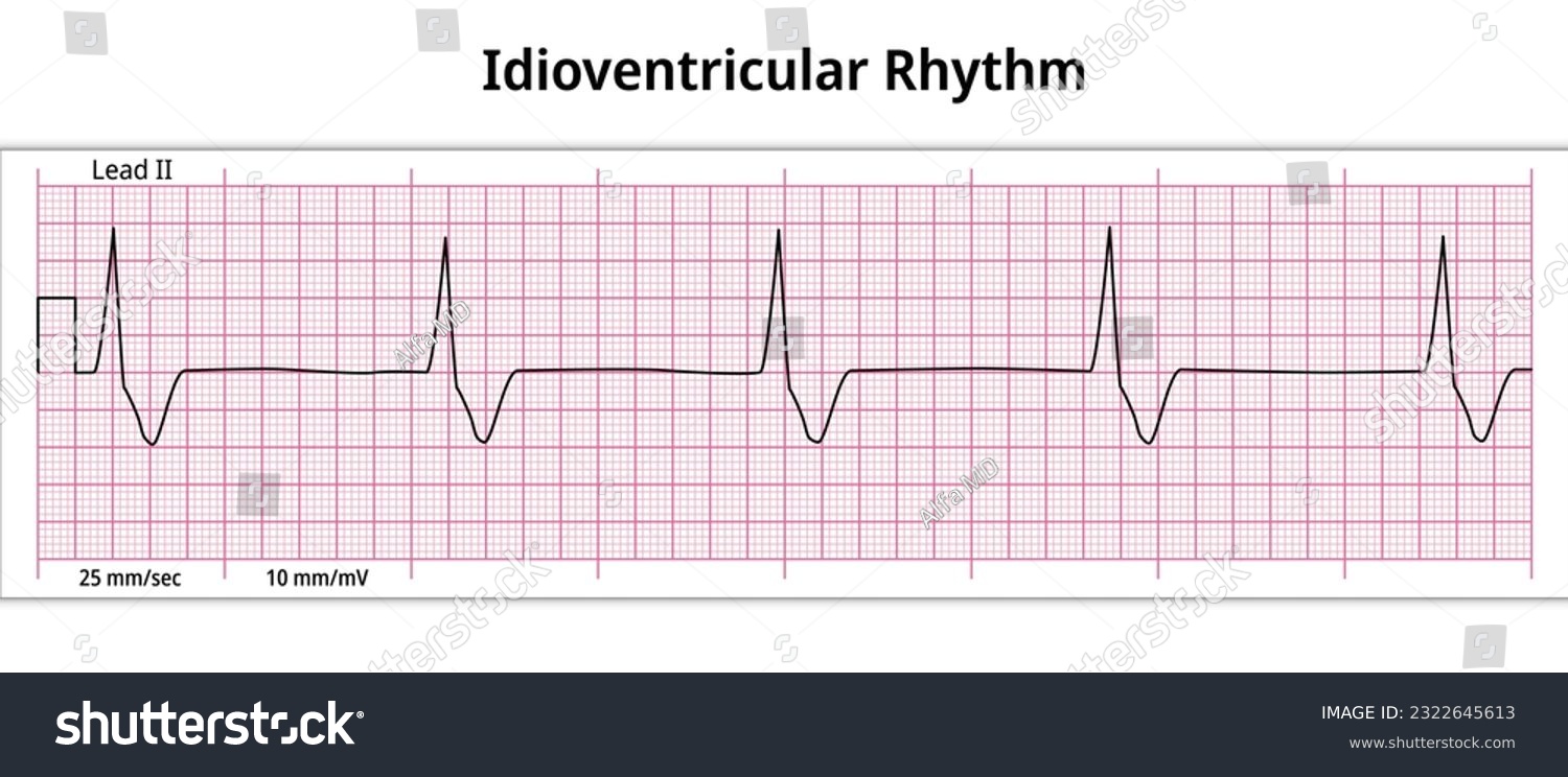 ECG Idioventricular Rhythm - 8 Second ECG Paper - Royalty Free Stock ...