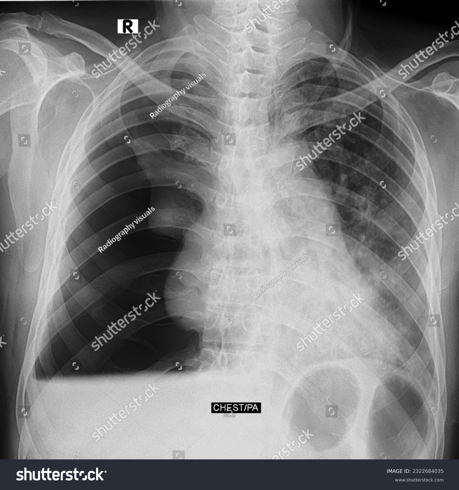 pleural effusion chest x ray. chest x ray with - Royalty Free Stock ...