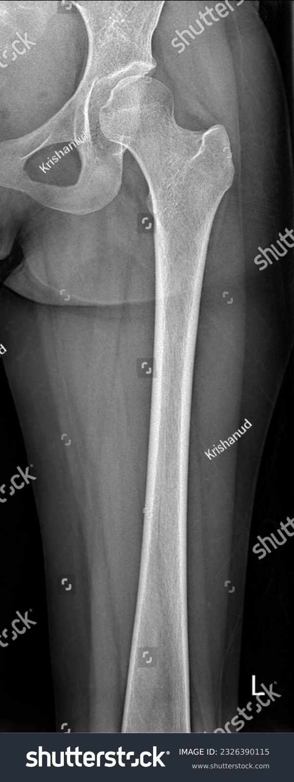 Normal Real X ray of Femur  #2326390115