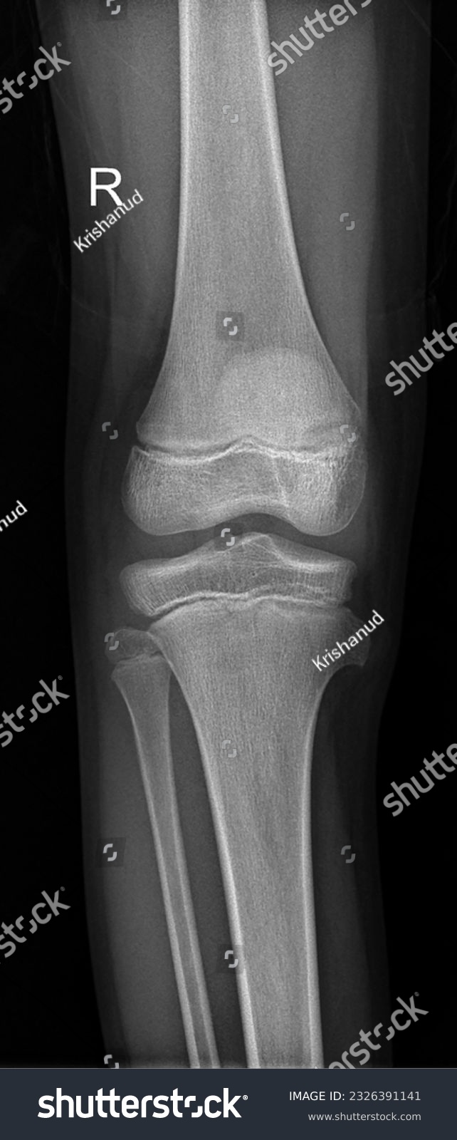 Child knee joint x-ray  showing distal femur tibia and fibula  #2326391141