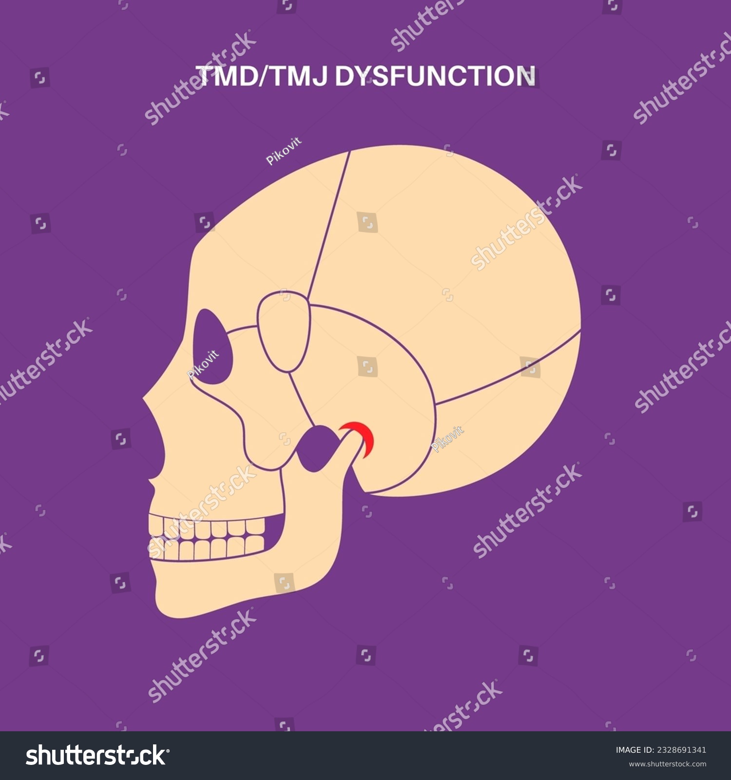 Temporomandibular joint disorder. TMD or TMJ - Royalty Free Stock ...