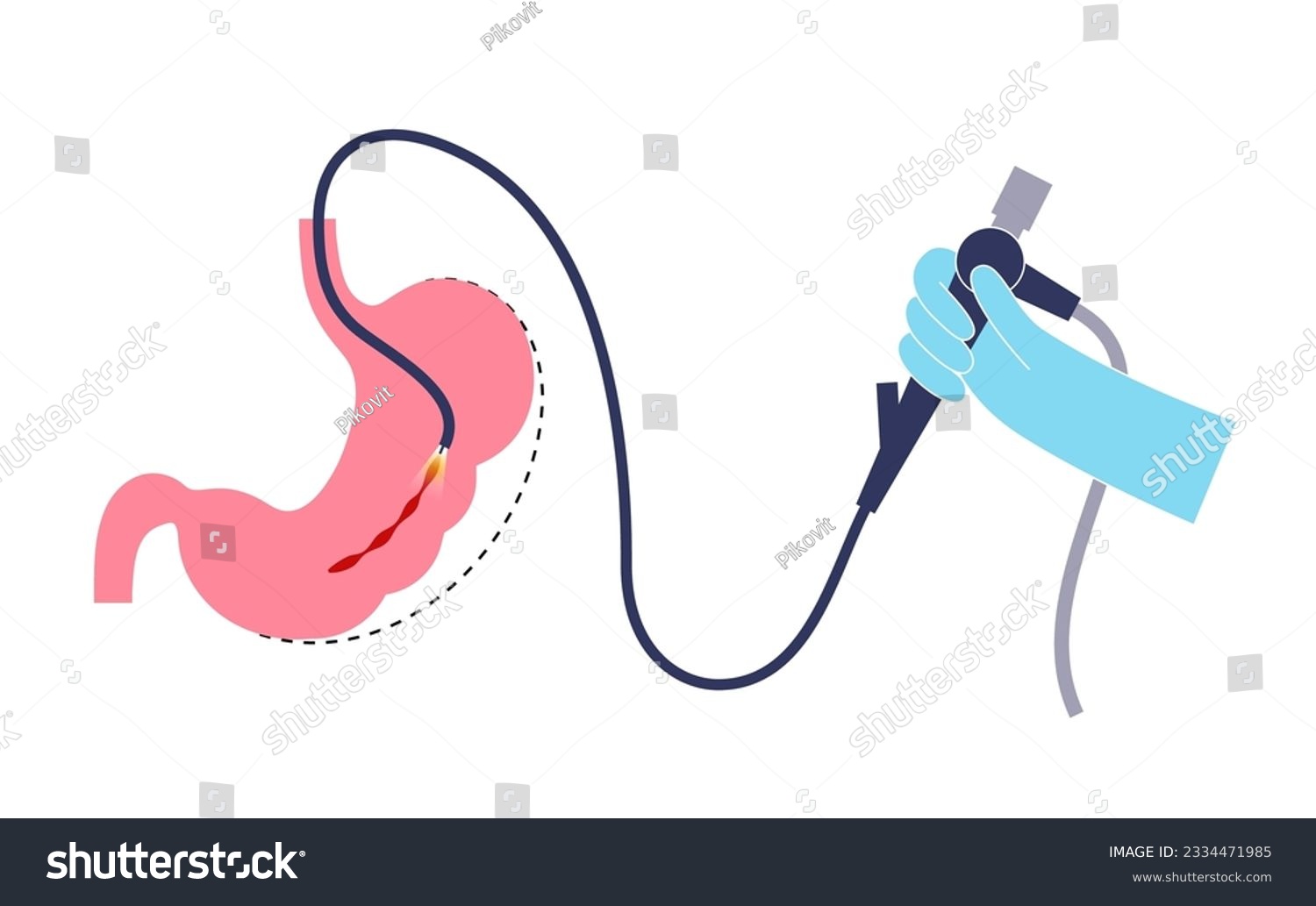 Endoscopic sleeve gastroplasty. Stomach surgery, - Royalty Free Stock ...