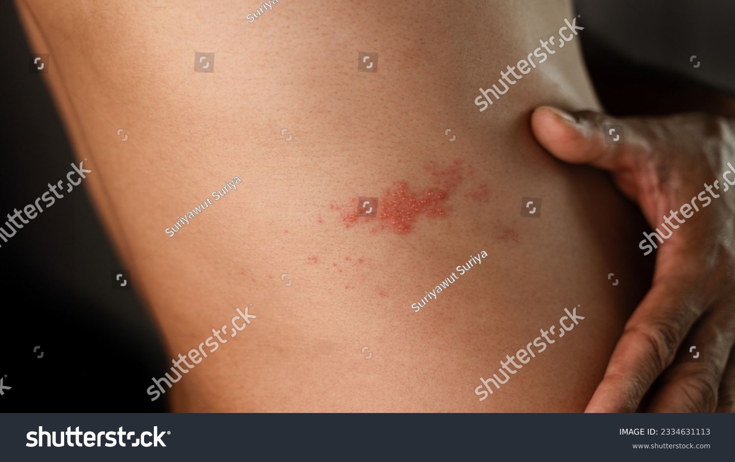 Man with shingles disease, skin infected with Herpes zoster, virus, Healthcare and medical. #2334631113