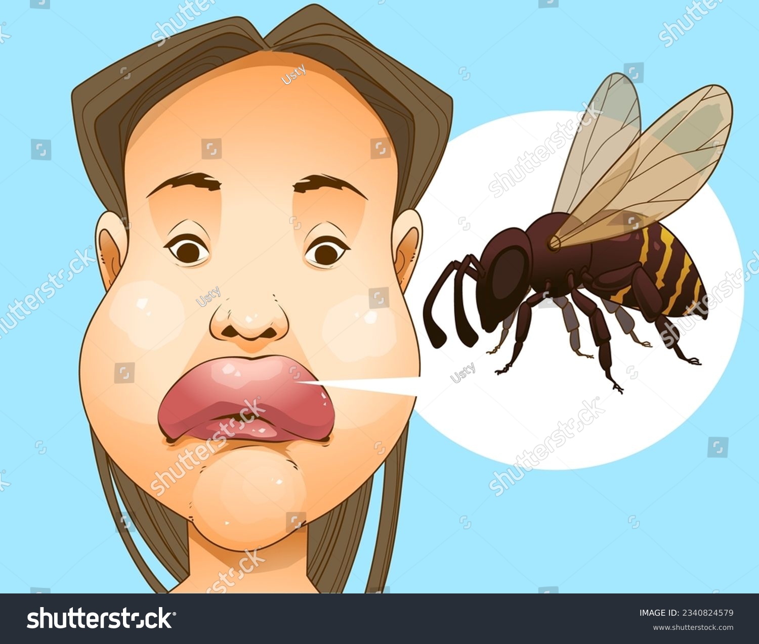 Bee sting. Swollen face. Swollen lips. Injury - Royalty Free Stock ...