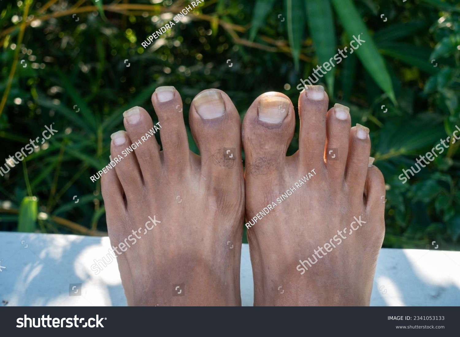 Oct.14th 2022 Uttarakhand, India. Neglected foot nails of an Indian adult with unhygienic feet conditions. Concept of self-care and personal hygiene. #2341053133