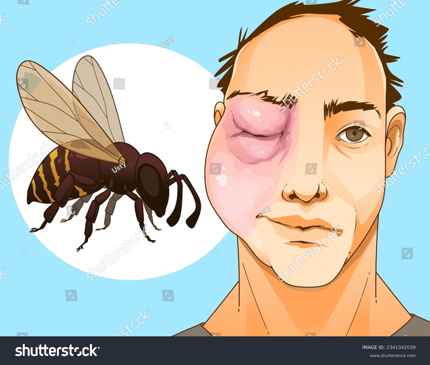 bee-sting-swollen-face-swollen-eye-injury-royalty-free-stock