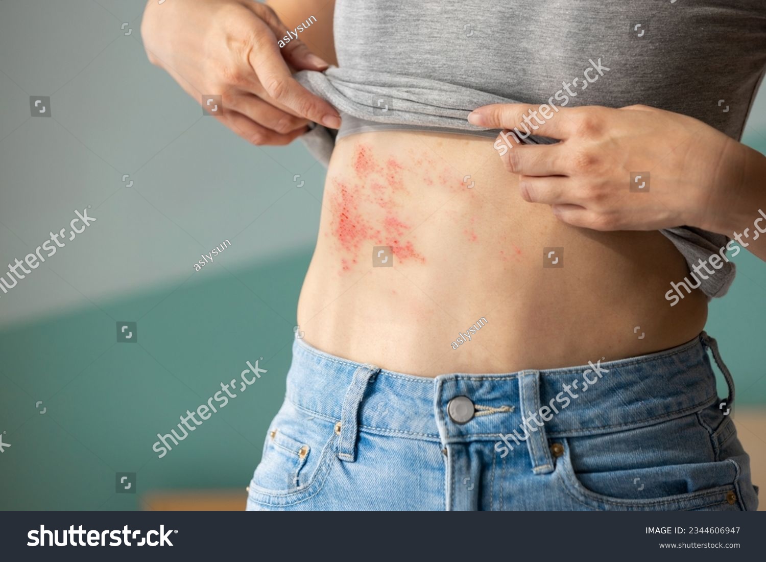 Woman with shingles on the skin she feels very painful #2344606947