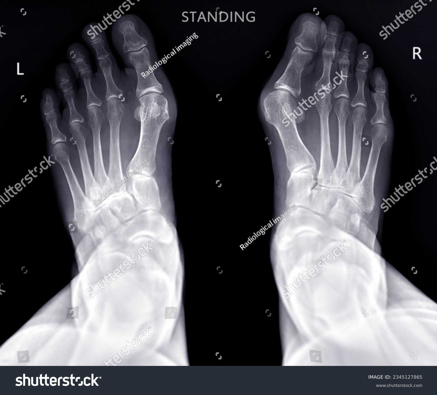 Foot x-ray image  AP  standing view  isolated on black background. #2345127865