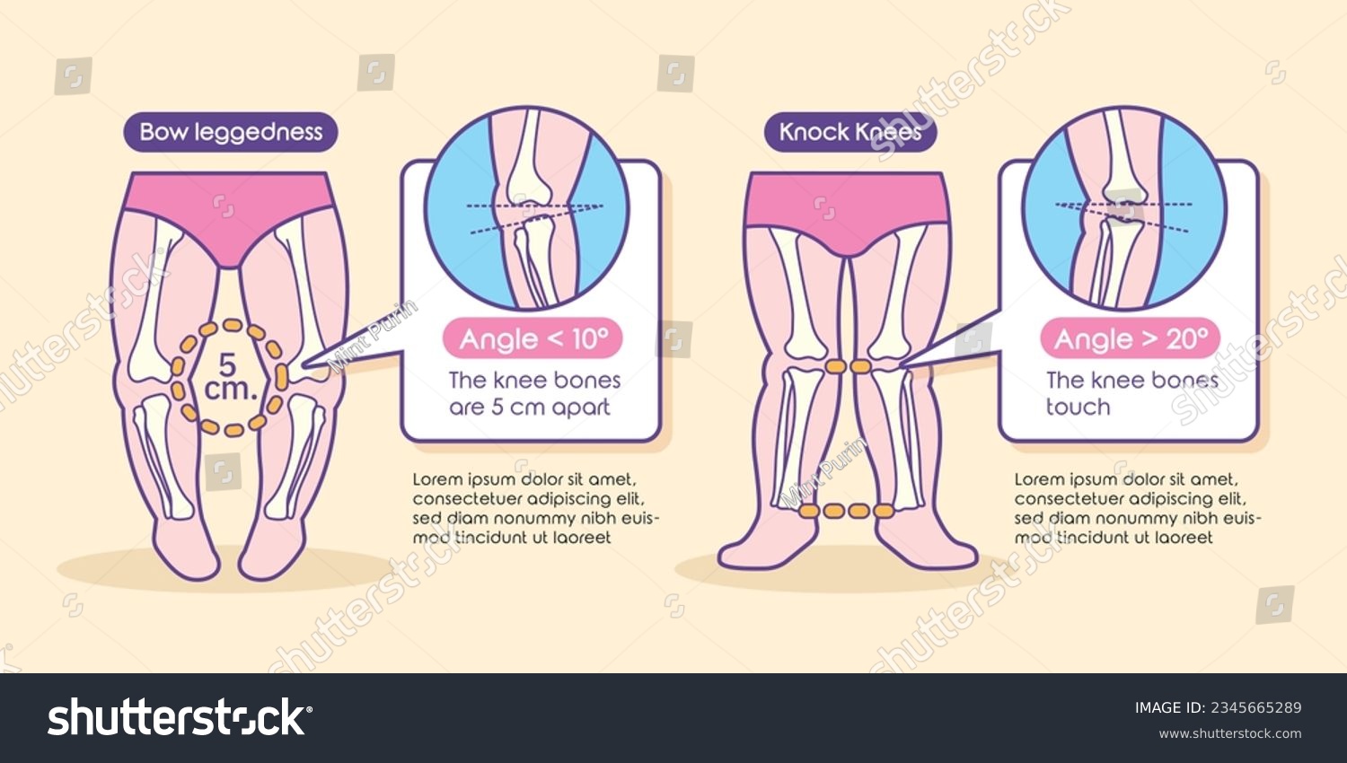 Varus and valgus knee deformity for Baby and Kid - Royalty Free Stock ...