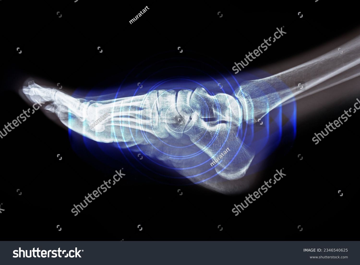 Foot pain on x-ray on black background #2346540625