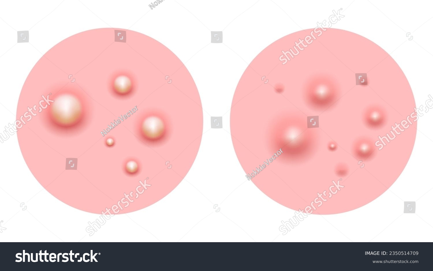 Acne skin pimple, vector illustration - Royalty Free Stock Vector ...