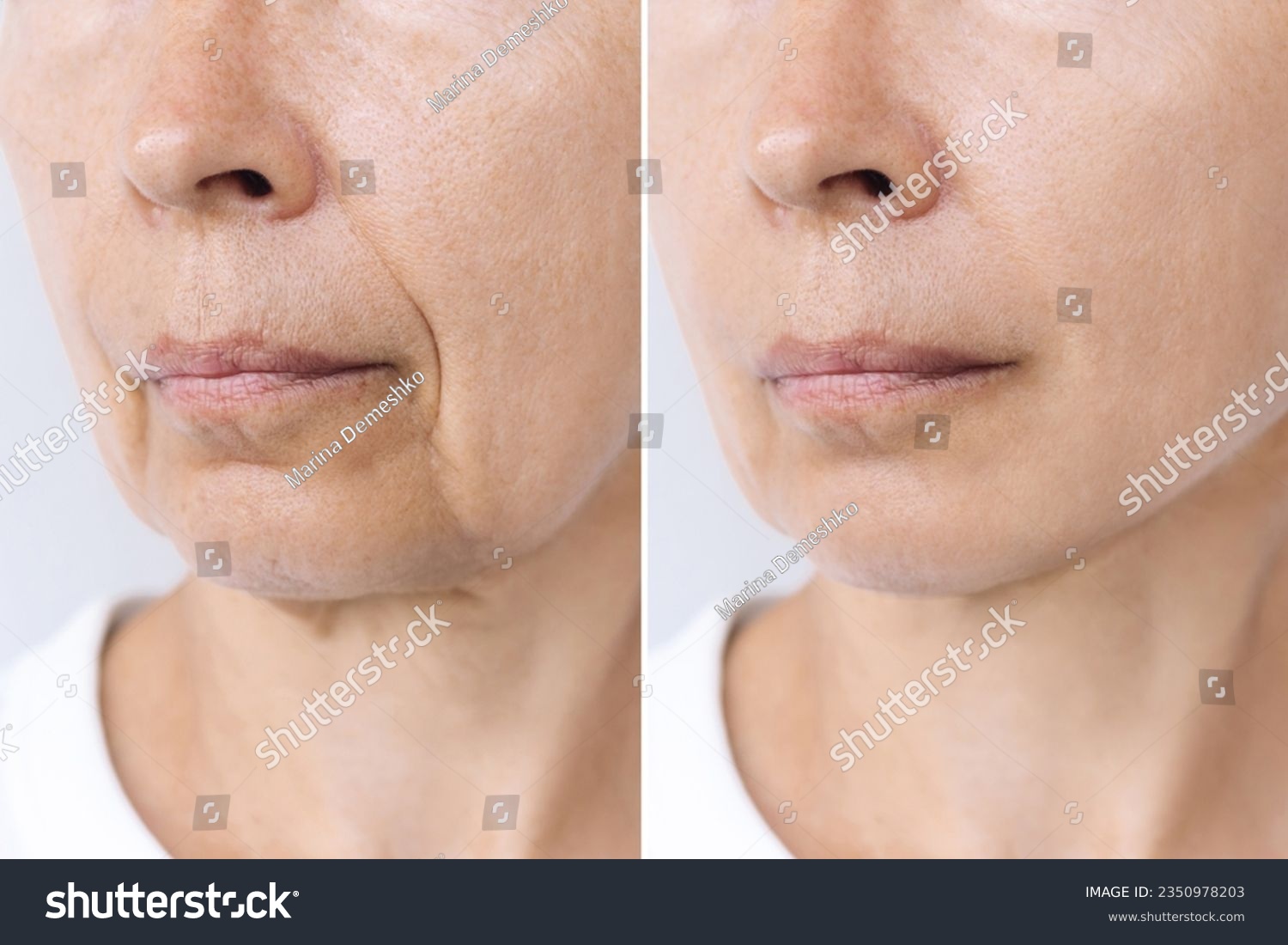 Lower part of elderly woman's face and neck with signs of skin aging before after facelift, plastic surgery. Age-related changes, flabby sagging skin, wrinkles, creases. Rejuvenating procedures #2350978203