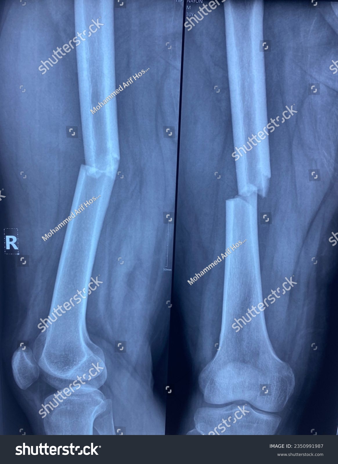 X ray of right femur Anterior posterior and - Royalty Free Stock Photo ...