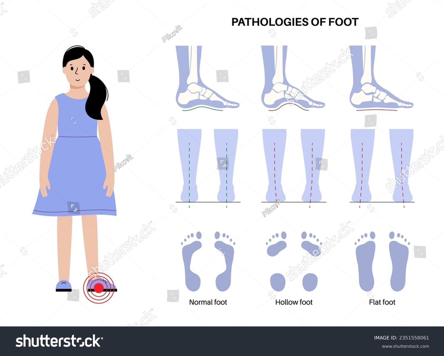 Foot pathologies anatomical poster. Flat, normal - Royalty Free Stock ...