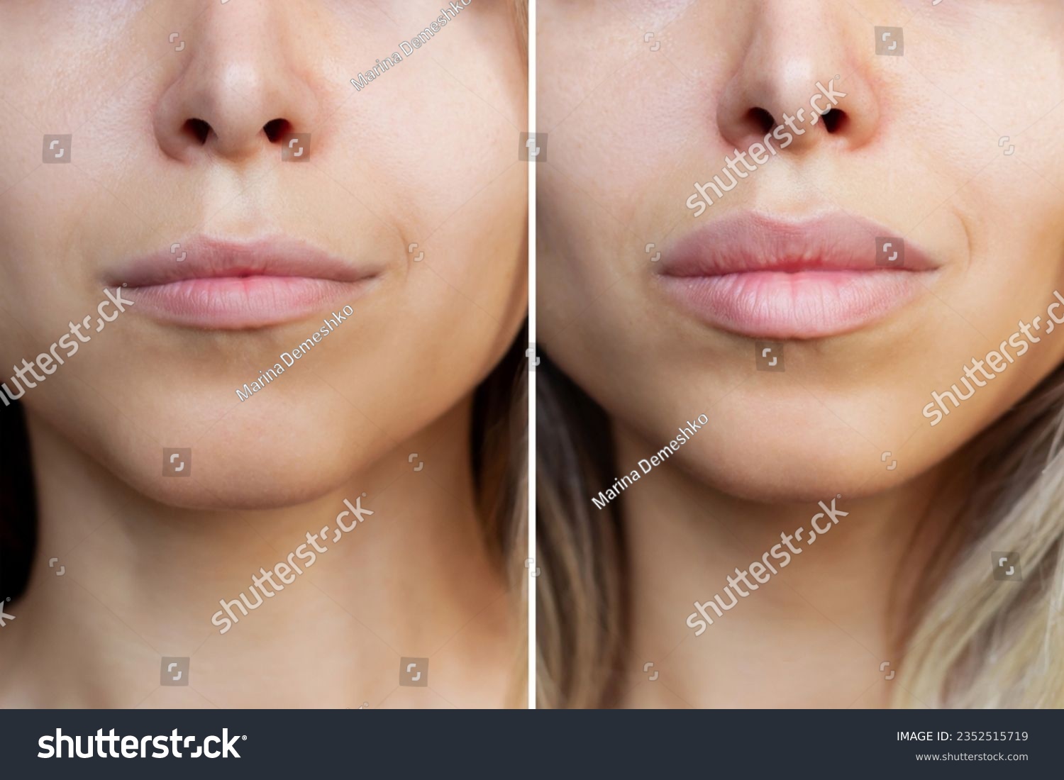 Result of lip augmentation. Cropped shot of young blonde woman's lower part of face with lips before and after lip enhancement. Injection of filler in lips. Difference, comparison #2352515719
