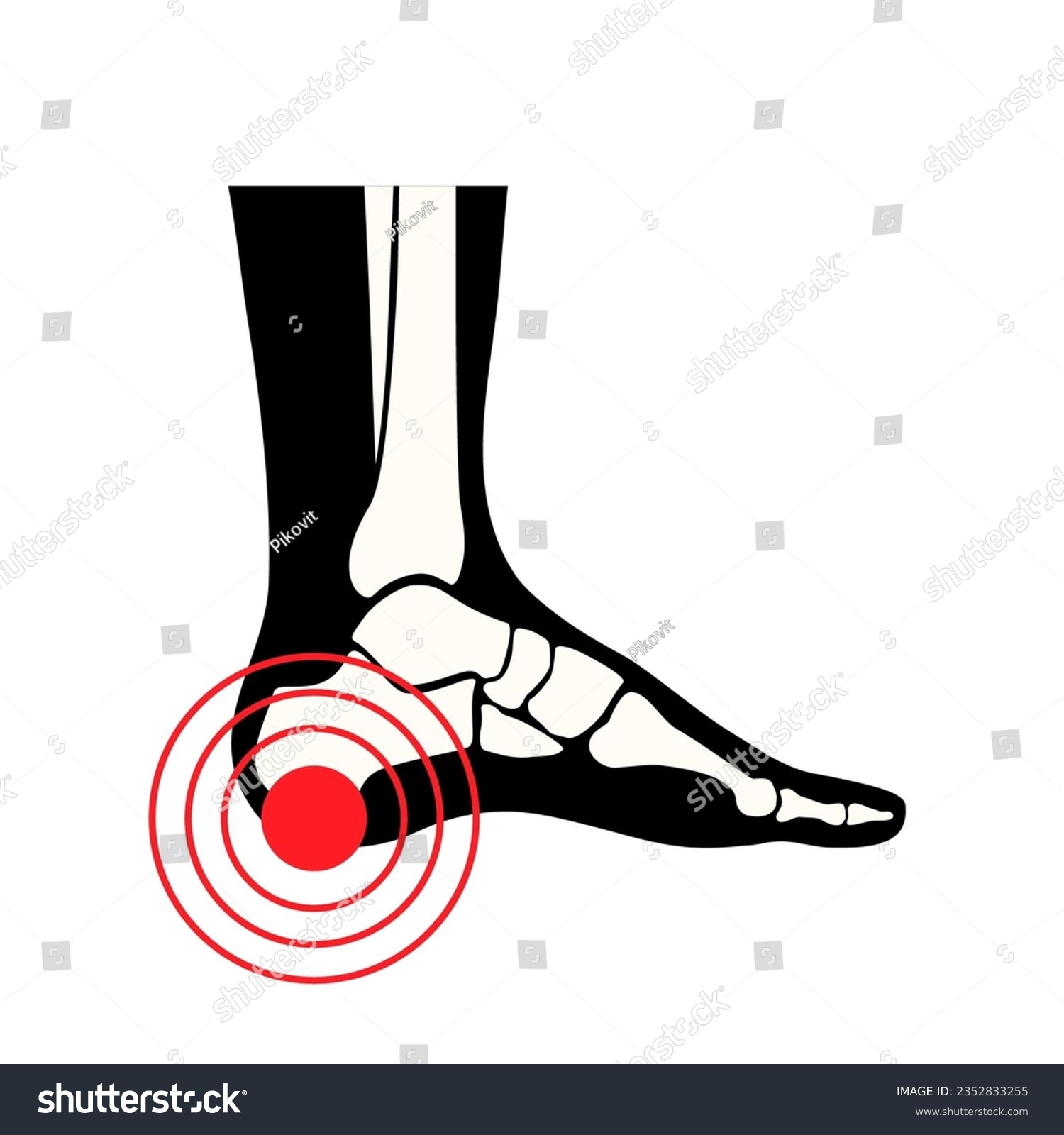 Pain of the heel anatomical poster. Ankle and - Royalty Free Stock ...