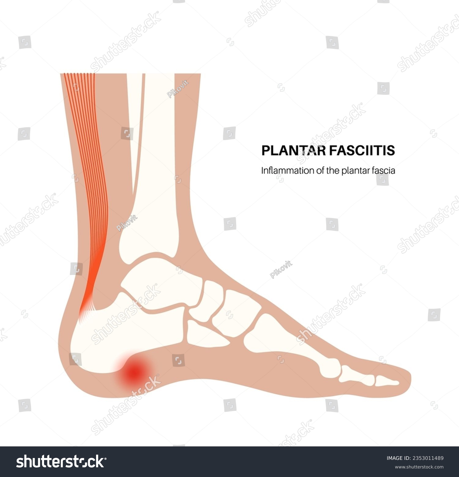 Plantar fasciitis anatomical poster. Stretches - Royalty Free Stock ...