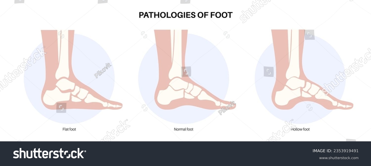 Foot pathologies anatomical poster. Flat, normal - Royalty Free Stock ...