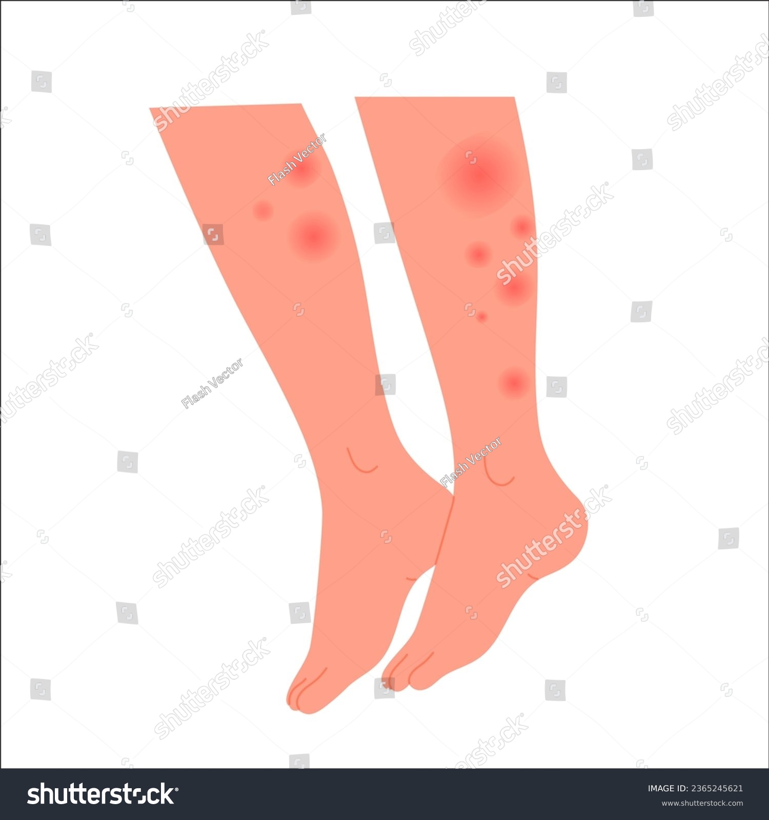 Human legs covered with red rash. Feet with - Royalty Free Stock Vector ...