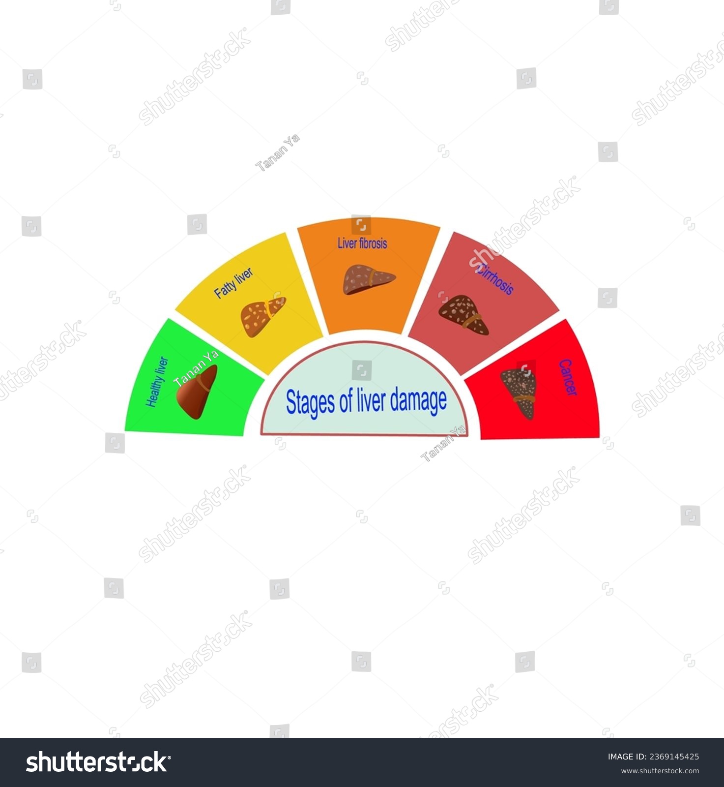 Stages Liver Damage infographic concept, vector - Royalty Free Stock ...