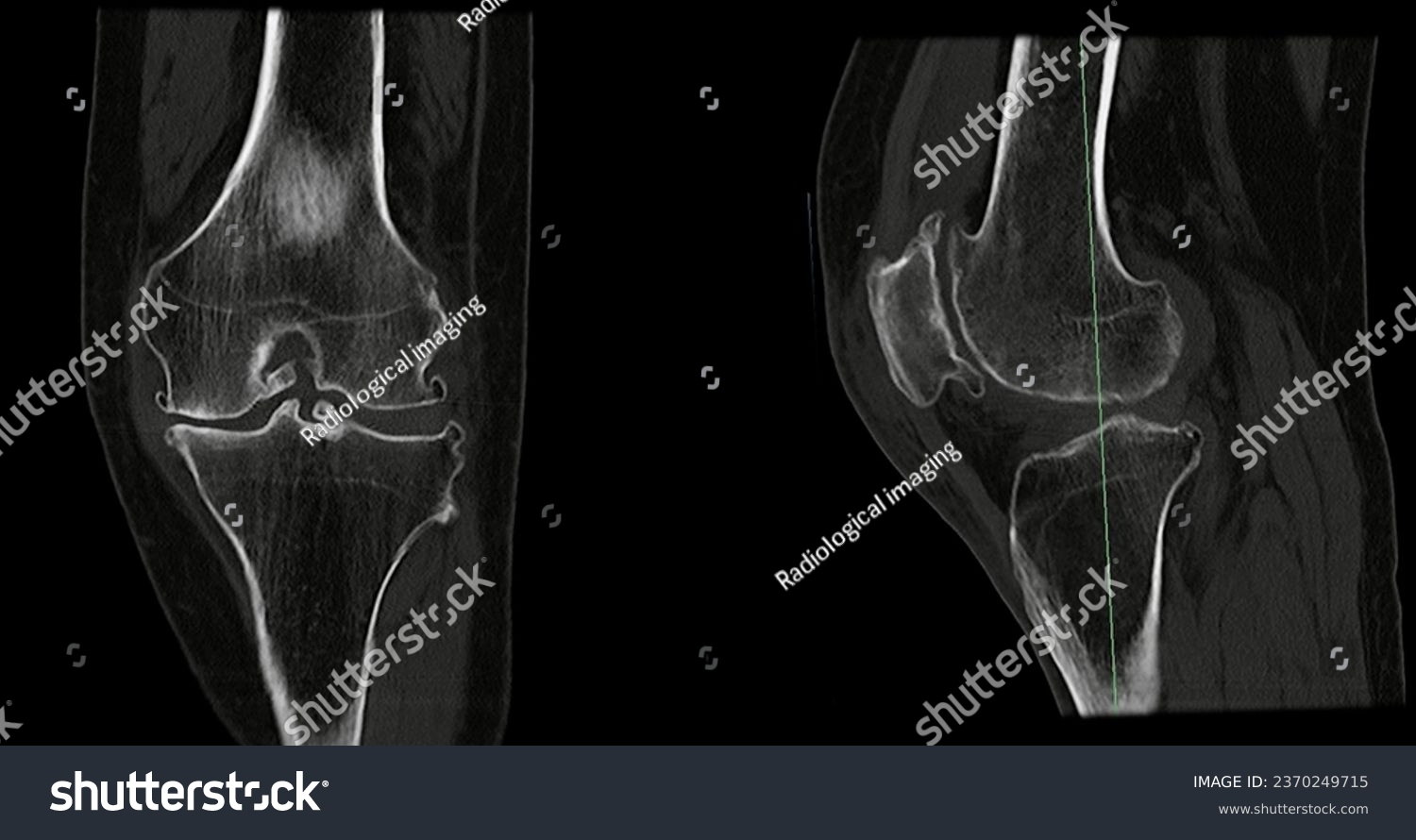 CT Scan of Knee joint sagittal and coronal in case fracture patella bone. #2370249715