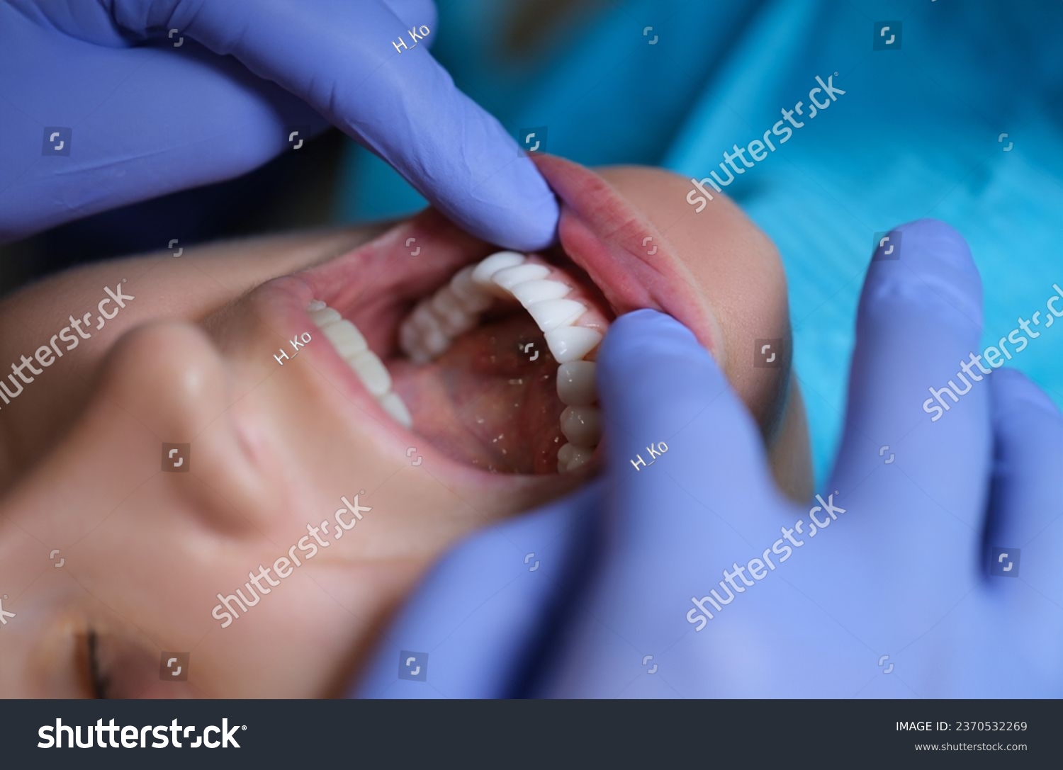 Doctor dentist examining patient oral cavity with veneers closeup. Installation of composite and zirconium veneers concept #2370532269
