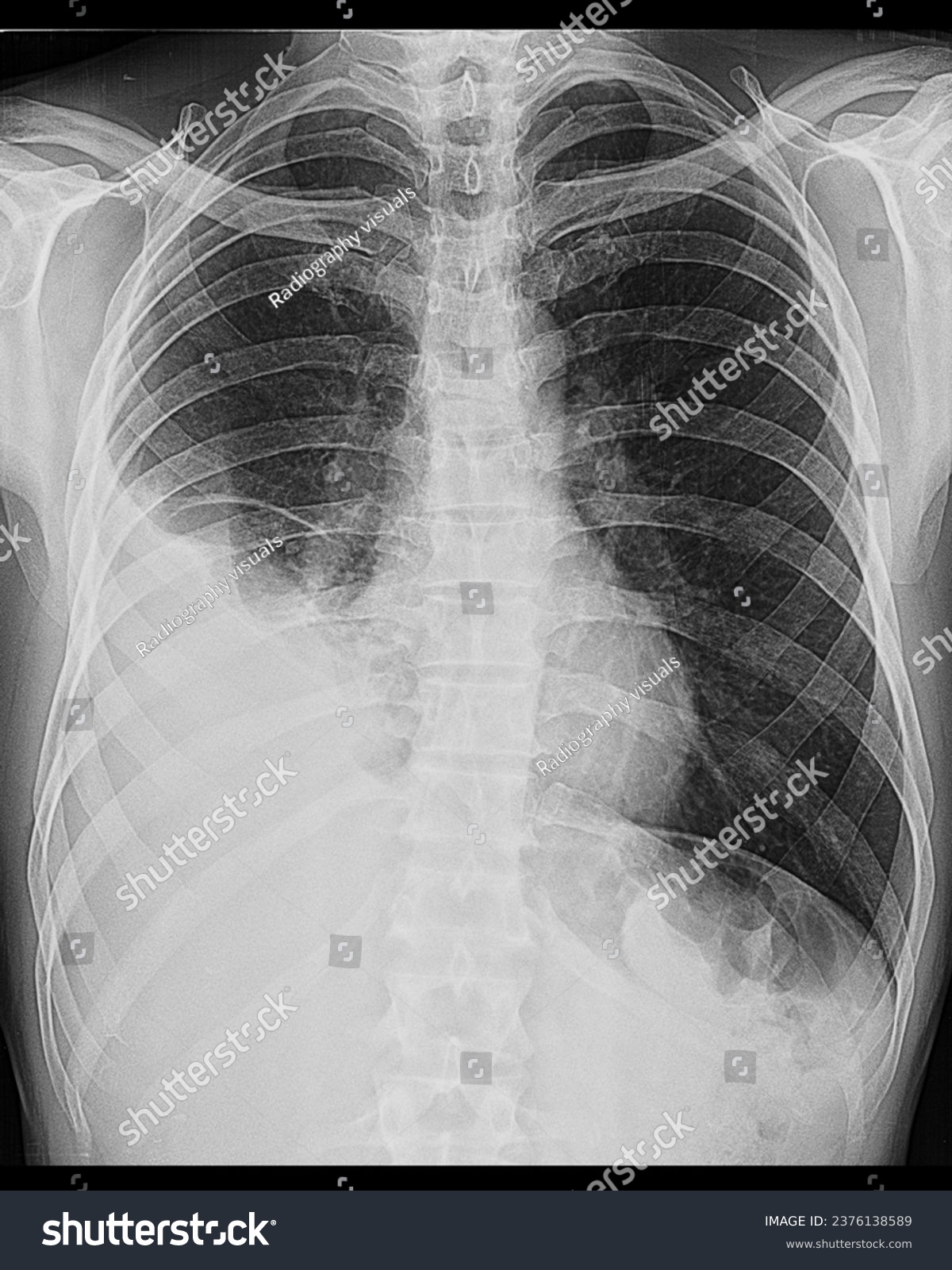 Chest x ray with Right Pleural effusion. Pleural - Royalty Free Stock ...