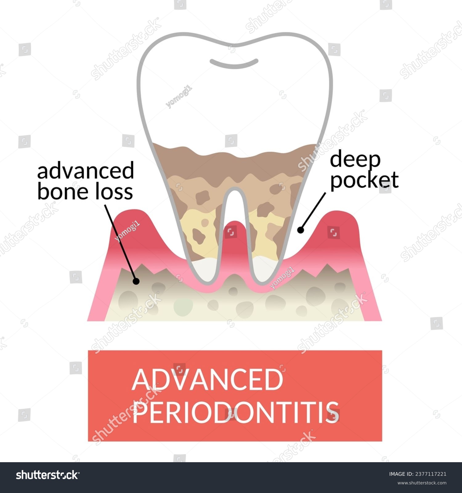 periodontal pocket and bone destruction. - Royalty Free Stock Vector ...