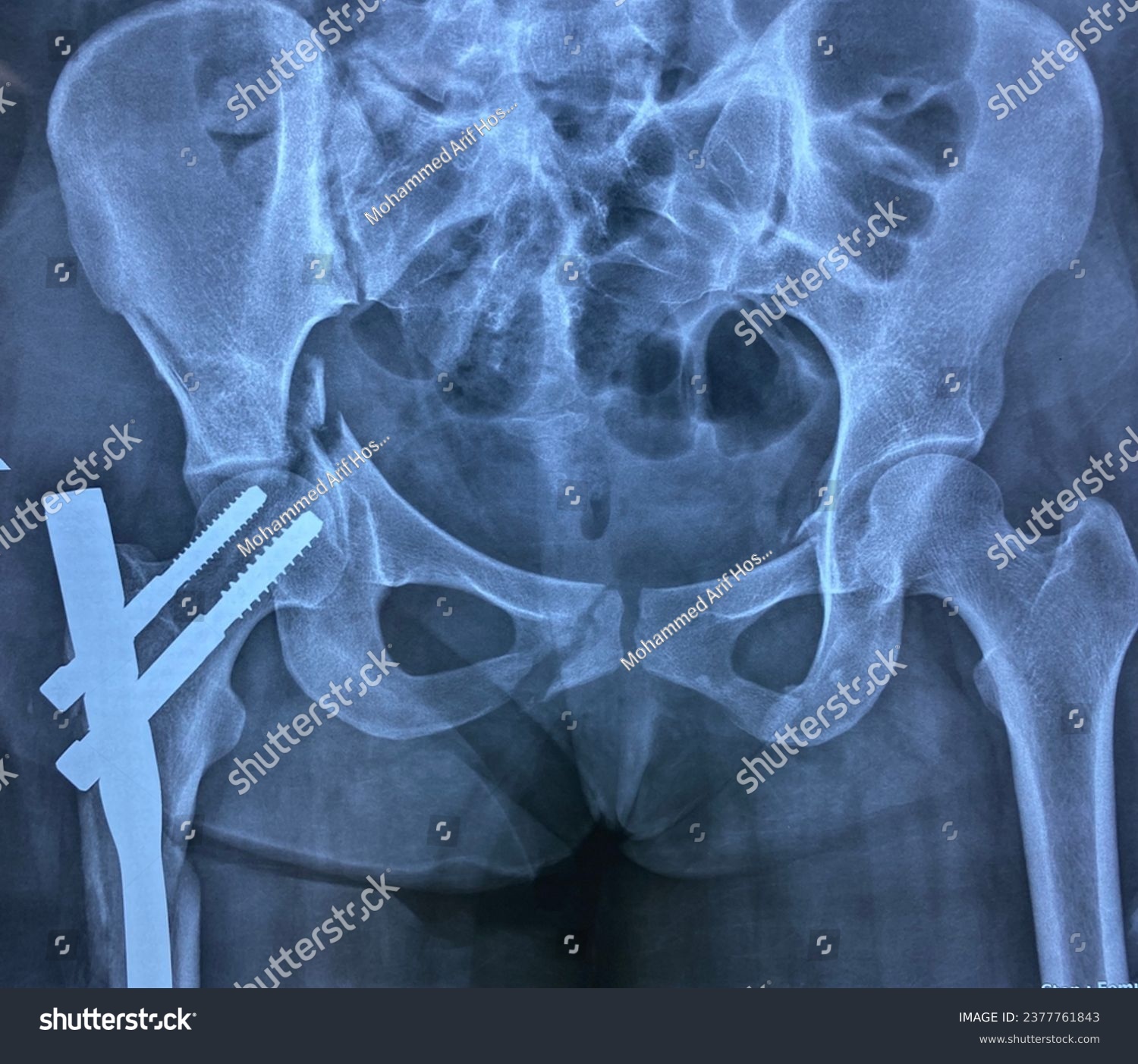 X ray of pelvis anterior posterior view - Royalty Free Stock Photo ...