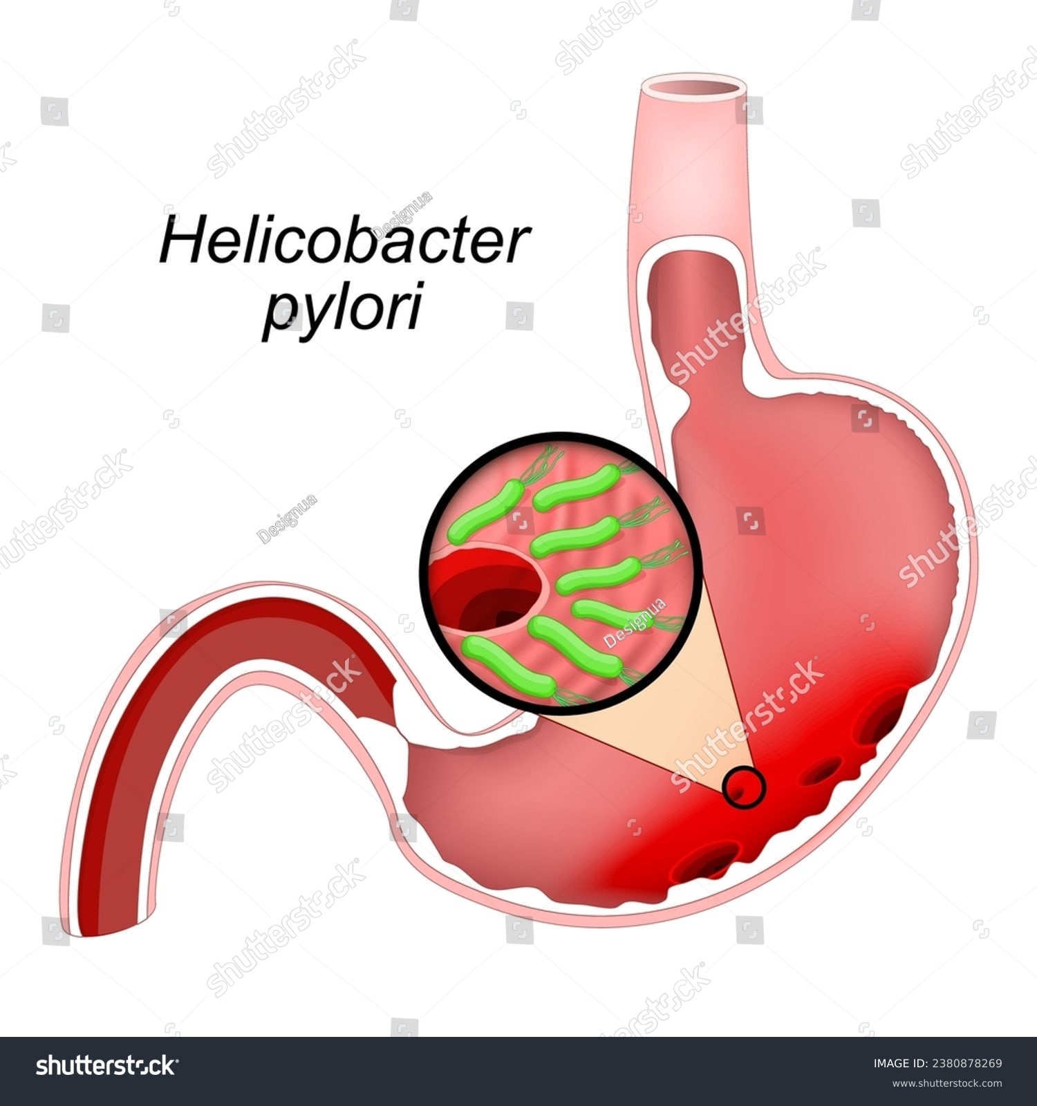 Cross section of a human Stomach with ulcers. - Royalty Free Stock ...