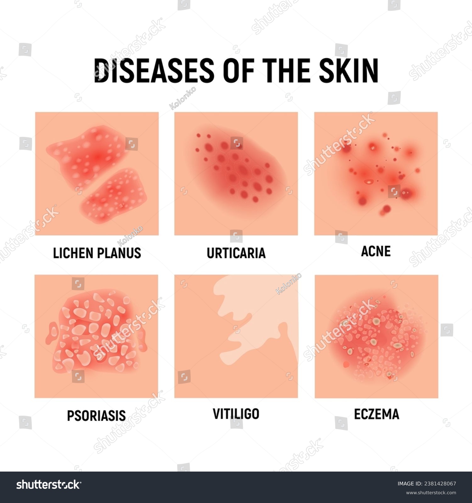 Psoriasis rash vector skin hand infection - Royalty Free Stock Vector ...