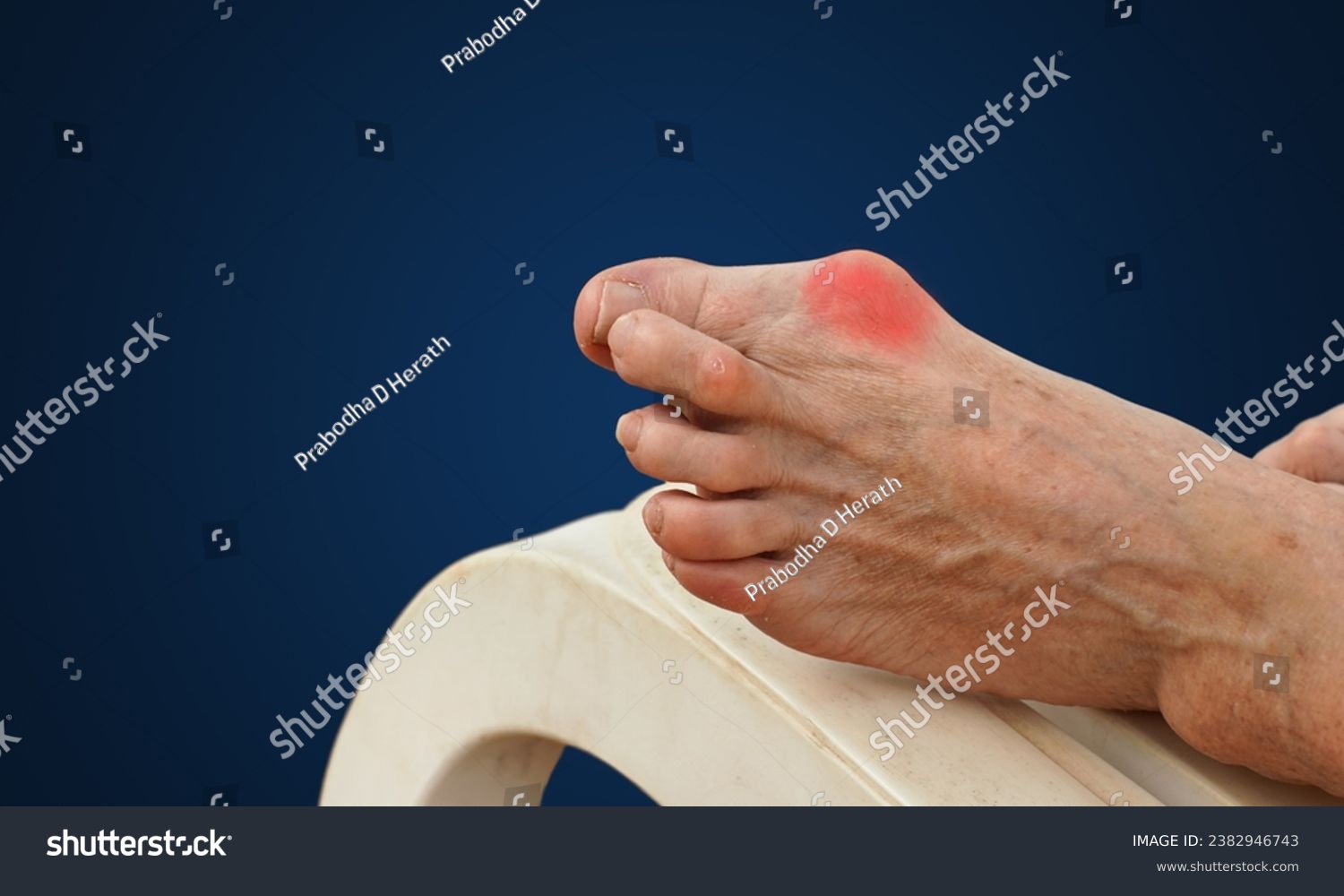  inflammation of the big toe bone. Hallux valgus, bunion in foot on dark blue  background. #2382946743