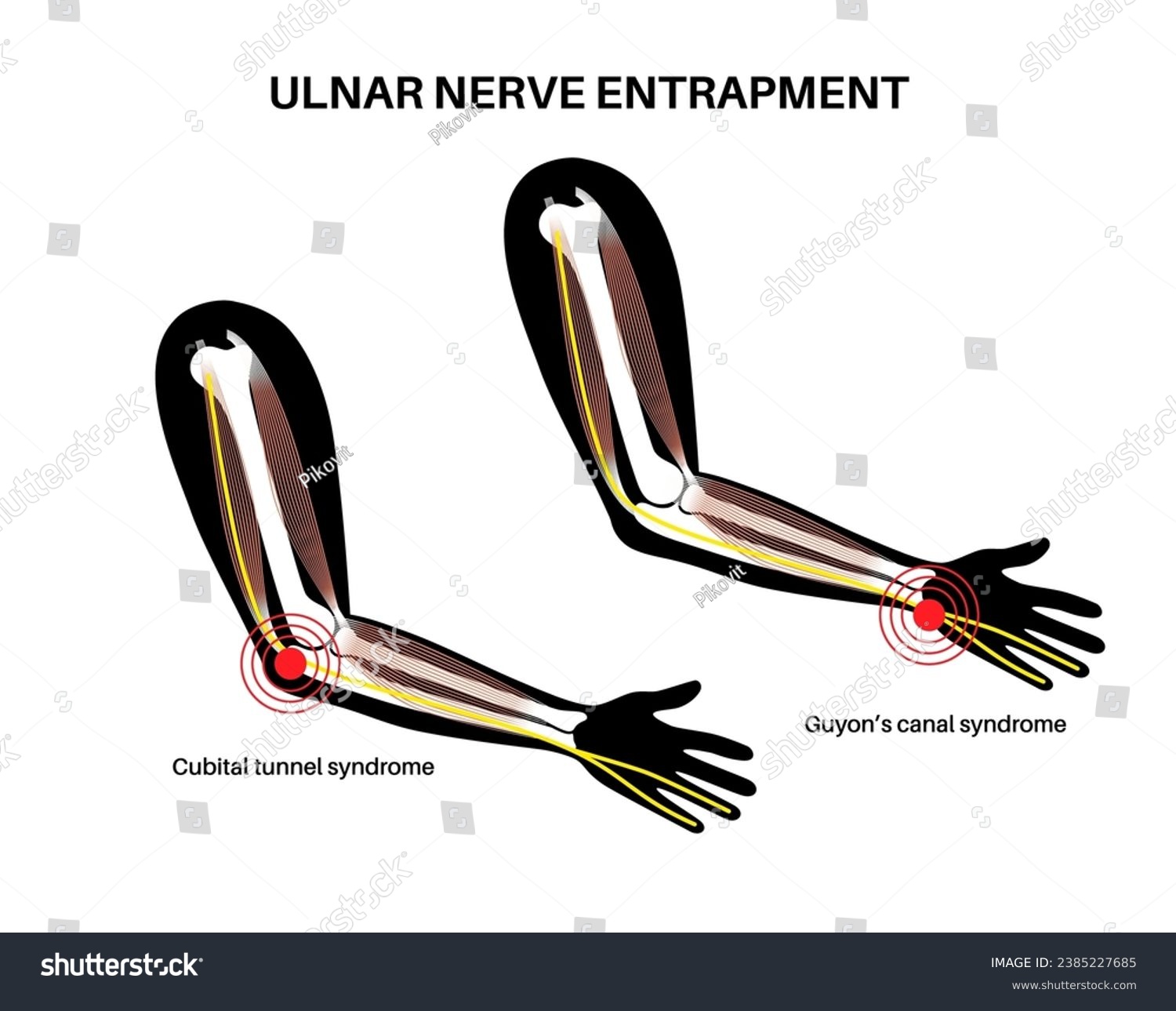 Ulnar nerve entrapment. Cubital tunnel syndrome - Royalty Free Stock ...