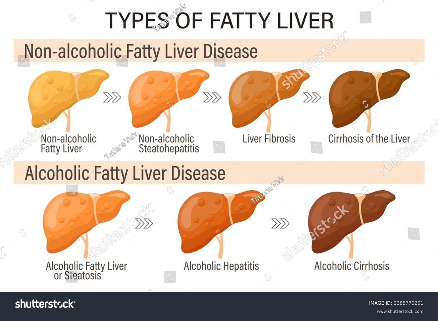 Types of fatty liver. Human liver diseases. - Royalty Free Stock Vector ...