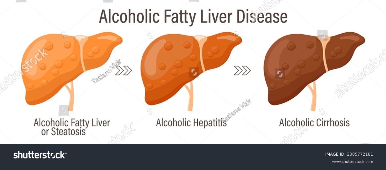 Types of fatty liver. Human liver diseases. - Royalty Free Stock Vector ...