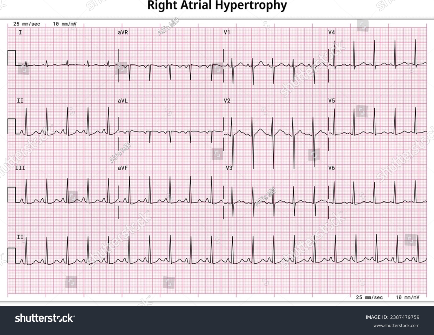 ECG Right Atrial Hypertrophy (RAH) - Right - Royalty Free Stock Vector ...