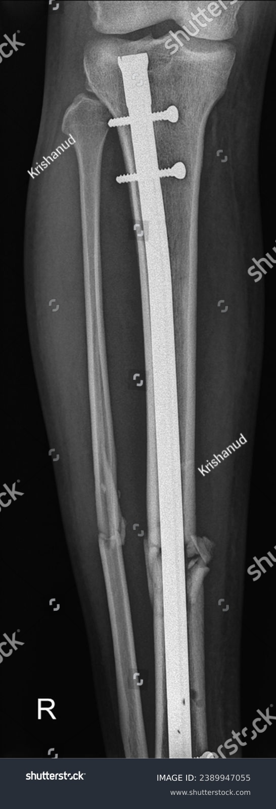 Tibial shaft Fracture Intramedullary Nail - Royalty Free Stock Photo ...