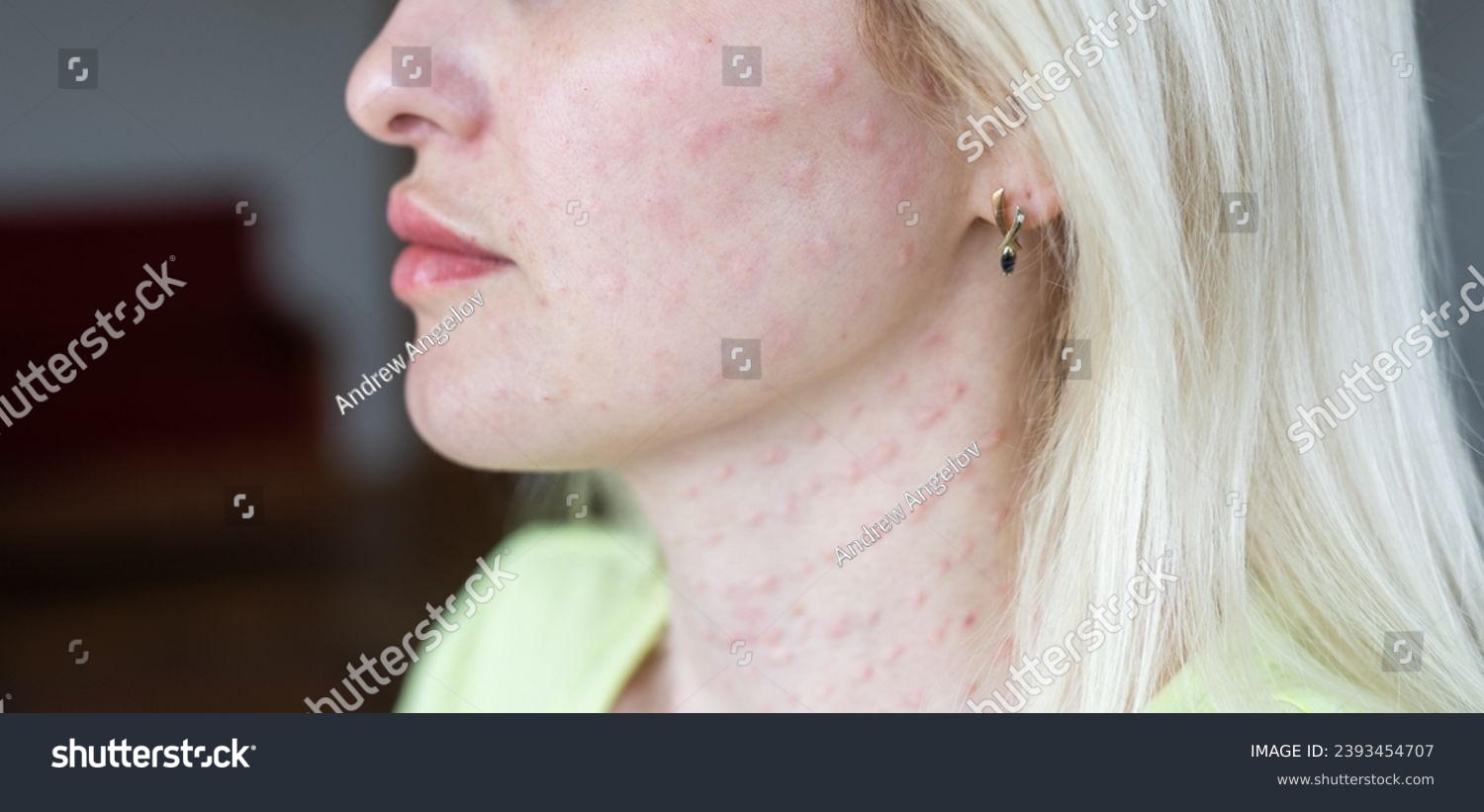 Real biorevitalization of the skin on a white background. Traces of injections of biorevitalization on the face of a woman. Traces of biorevitalization needles. #2393454707