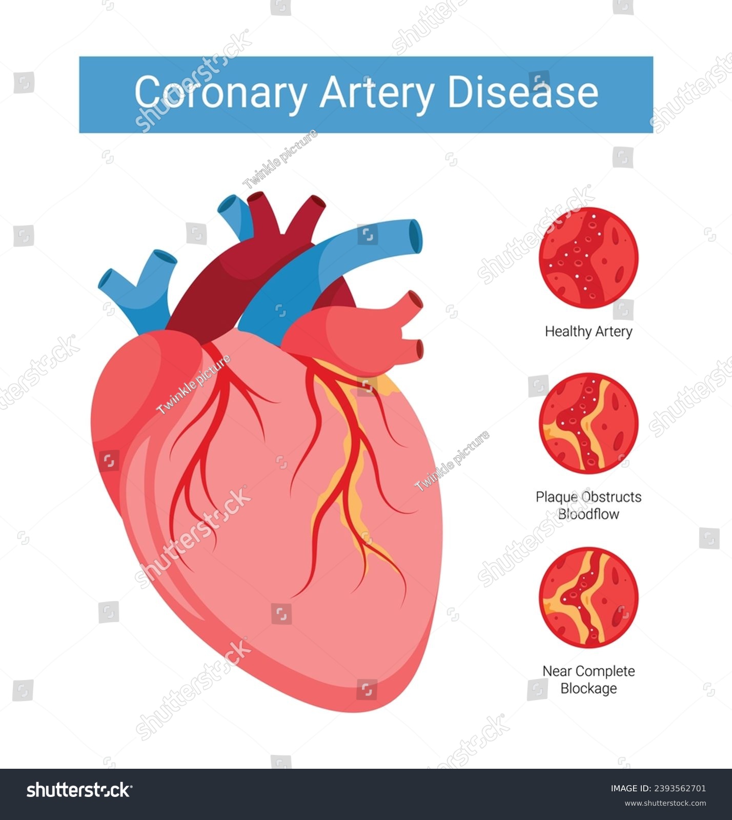 Stages of Coronary Artery Disease (CAD) - Royalty Free Stock Vector ...