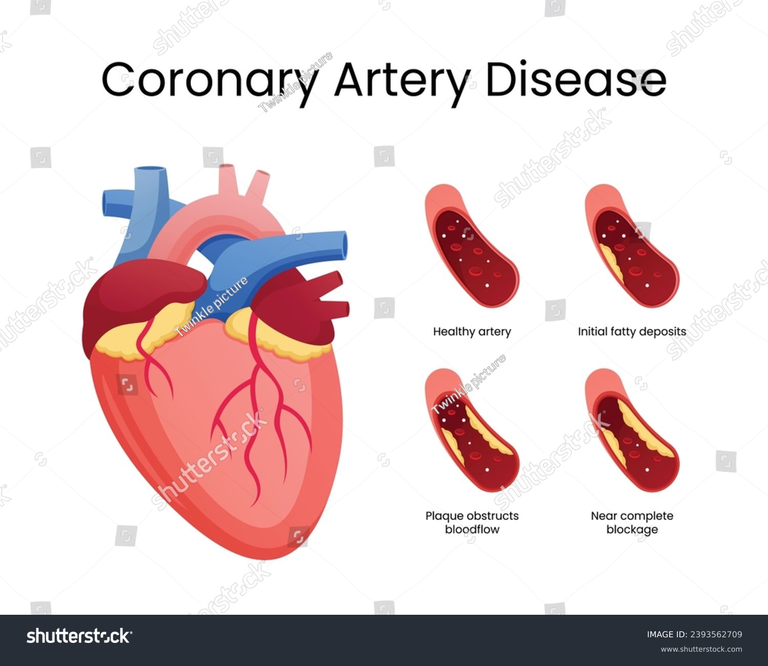 Stages of Coronary Artery Disease - Royalty Free Stock Vector ...