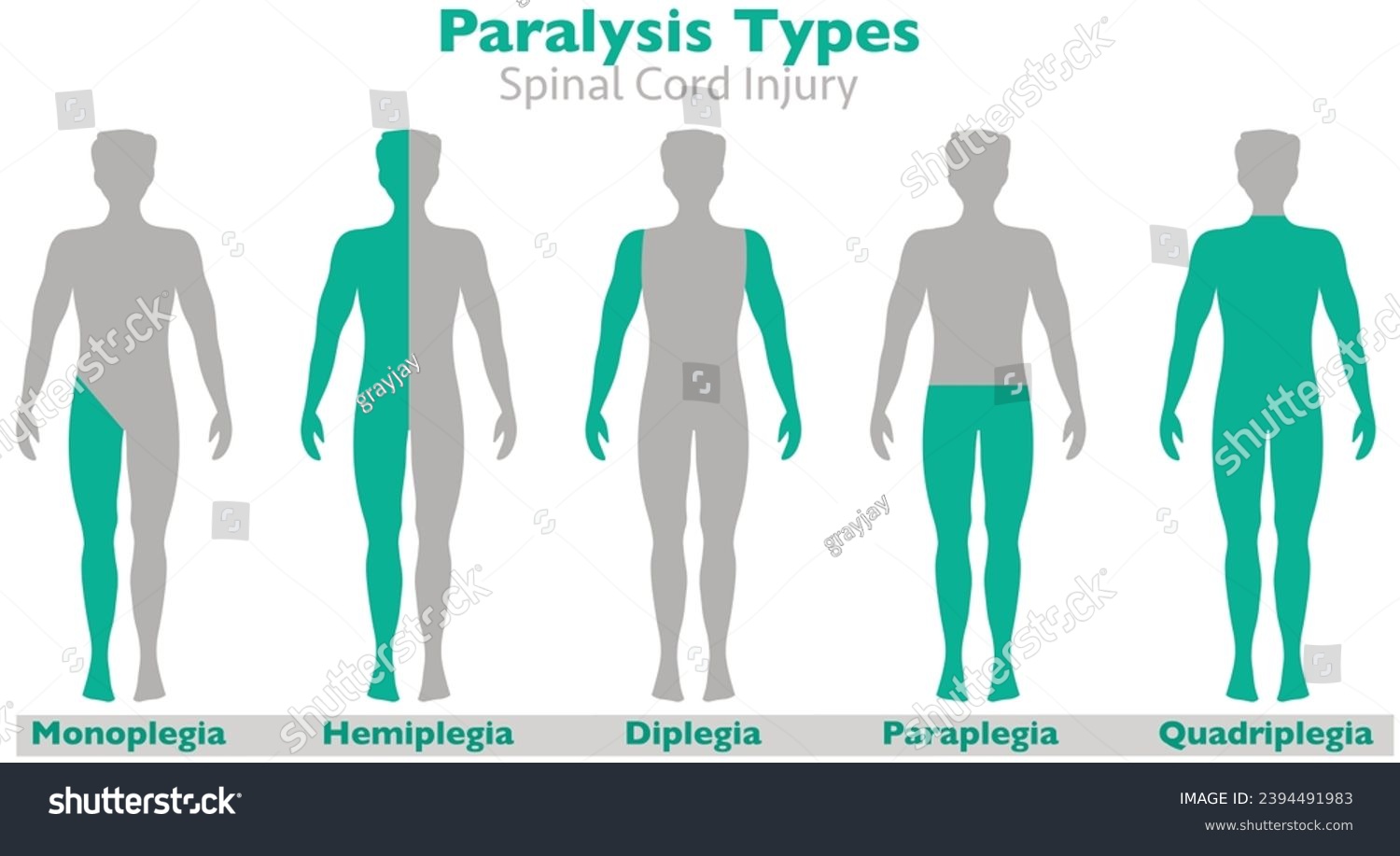 Paralysis types, spinal cord injury. Hemiplegia, - Royalty Free Stock ...