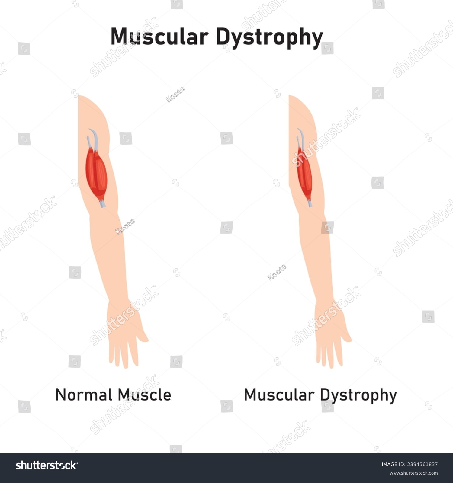 Duchenne Muscular Dystrophy (DMD) Scientific - Royalty Free Stock ...