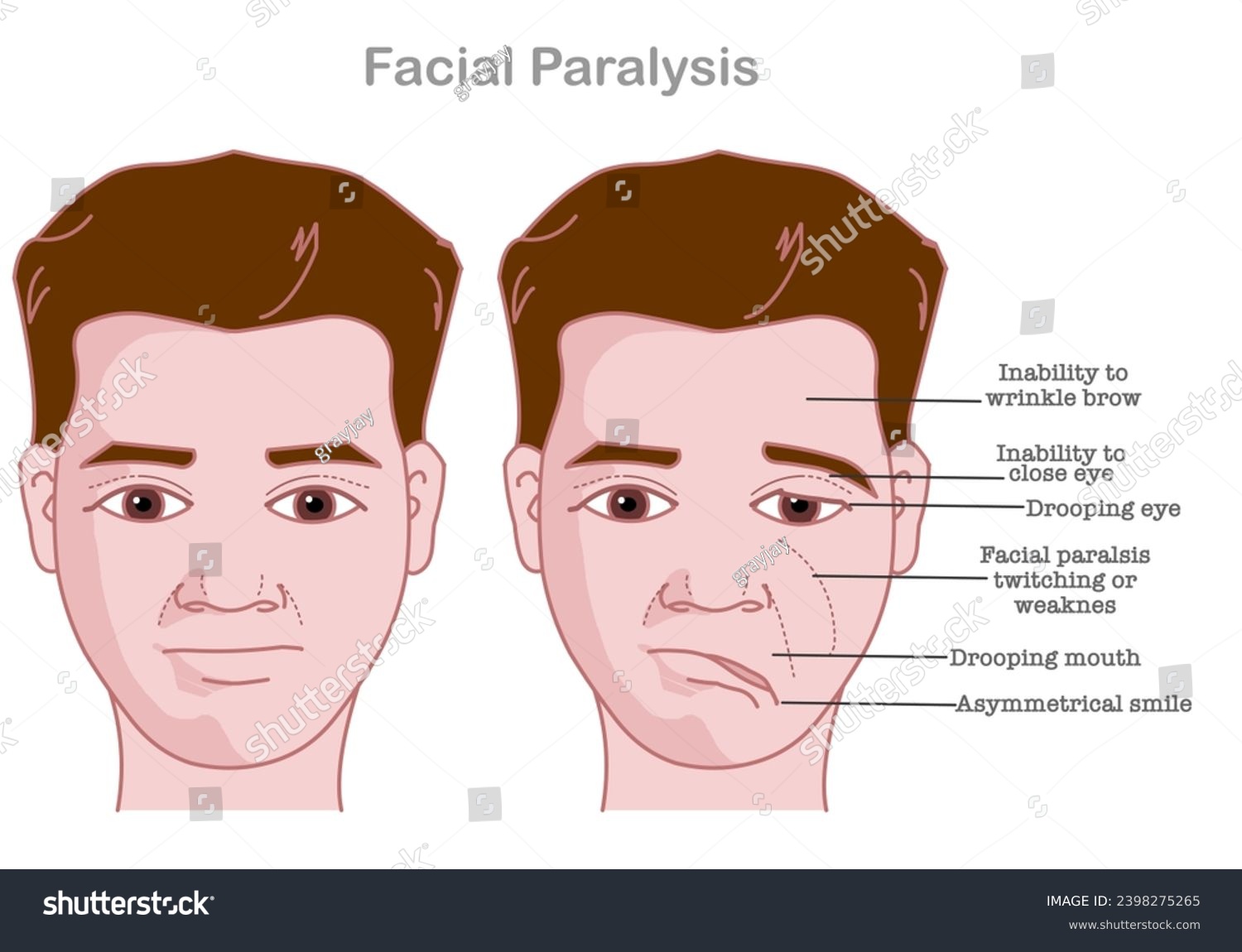 Facial paralysis. Bell palsy. Drooping eyes. - Royalty Free Stock ...