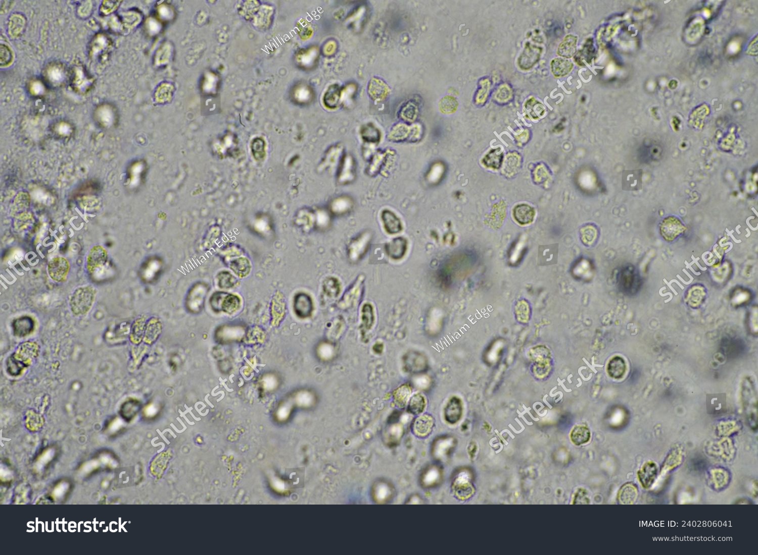 Coughing up mucus and phlegm from a chest infection from a virus and bacteria infection, looking at it under the microscope, with cells and microorganisms. Bacteria and skin cells #2402806041