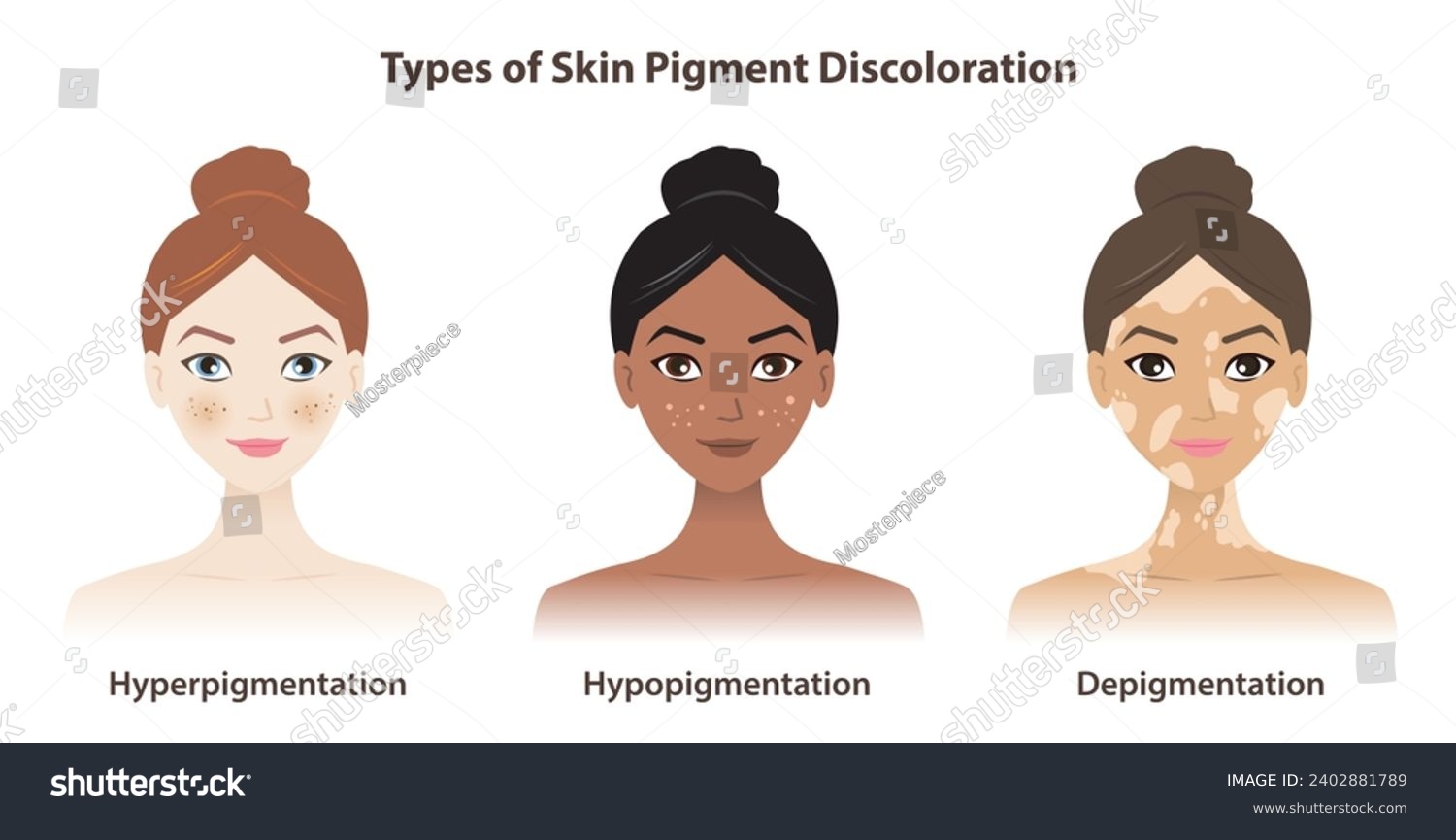 Types of skin pigment discoloration vector - Royalty Free Stock Vector ...